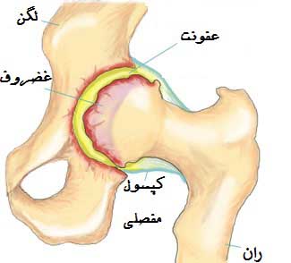 دررفتگي هاي اکتسابي مفصل ران